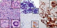 “Ring-form” megakaryocytic dysplasia in STAG2-mutated myelodysplastic neoplasm