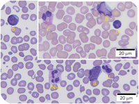 A neutrophil variant with dotlike eosinophilic granules in a child with transient abnormal myelopoiesis of Down syndrome