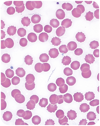 Soft tick relapsing fever in a traveler returning from Colorado