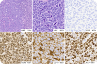 Flower cell morphology in high-grade B-cell lymphoma of the maxillary sinus