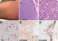 HHV-6 lymphadenitis with DRESS syndrome: another lymphoma mimic