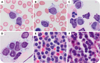 Pseudo-Chédiak-Higashi inclusions in a low-grade lymphoid neoplasm