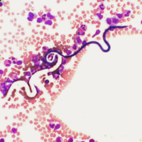 Microflaria Seen in Peripheral Blood Smear
