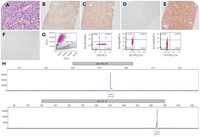 A case of Richter transformation to diffuse large B-cell lymphoma with aberrant T-cell marker expression