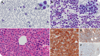 AML, myelodysplasia related, with STAG2 and SRSF2 comutations with myelocyte arrest