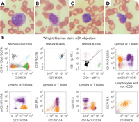 Circulating composite B- and T-cell lymphoma