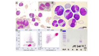A Tale of Primary Plasma Cell Leukemia in Young