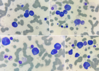 Plasma cell myeloma 1