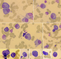 Plasma cell myeloma 2