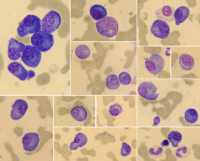 Plasma cell myeloma 3