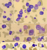 Plasma cell myeloma 4