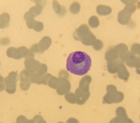 Plasma cell myeloma