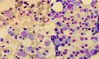 Plasma cell myeloma 2