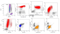 APML with Auer Rods; Flow cytometry 3