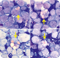 Leukemic myeloblasts with erythrophagocytosis