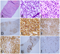 Follicular Lymphoma with Signet Ring-like Cells