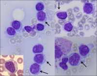 Pseudo Auer rods in Splenic marginal zone lymphoma. 1