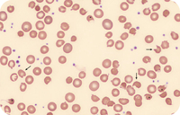 Oxidative hemolysis due to phenazopyridine in the absence of G6PD deficiency