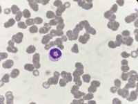 Ring neutrophil 1