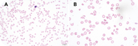 Pancreatitis-associated thrombotic microangiopathic hematolytic anemia with thrombocytopenia in a child