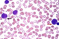 Blastic plasmacytoid dendritic cell neoplasm (BPDCN)-Peripheral blood smear