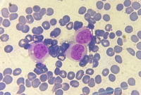 Acute monocytic leukemia 1