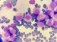 Acute monocytic leukemia 2