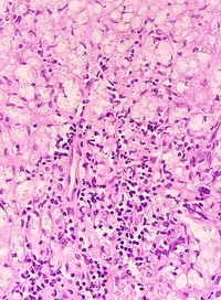 CRYPTOCOCCUS, Abdominal LN, H&E 400X