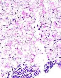 CRYPTOCOCCUS, Abdominal LN, Mucicarmine stain 400X