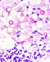 CRYPTOCOCCUS, Abdominal LN, Mucicarmine stain Oil immersion