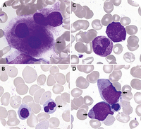 S56F UBA1 variant: a VEXAS syndrome subtype that follows its own path