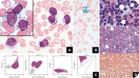 Auer rod–like inclusions in B-cell lymphoma mimicking therapy-related acute myeloid leukemia