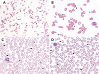 Parvovirus B19-induced autoimmune hemolytic anemia in hereditary elliptocytosis