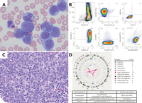 CD5-positive high-grade B-cell lymphoma with MYC, BCL2, and BCL6 rearrangements