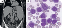 Prolymphocytic progression of splenic marginal zone lymphoma