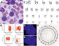 Acute myeloid leukemia with RUNX1::CBFA2T3 fusion