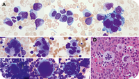 Megakaryocyte mitotic figures in de novo AML, myelodysplasia related, with STAG2, SRSF2, and ASXL1 comutations
