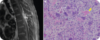Paraspinal mass and lower extremity weakness in a patient with thalassemia