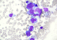 EBV-related Lymphoproliferative Disorder in Bone Marrow, Figure 1A