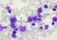 EBV-related Lymphoproliferative Disorder in Bone Trephine, Figure 1B