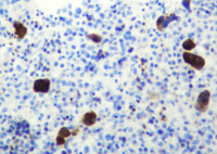 EBV-related Lymphoproliferative Disorder in Bone Trephine, Figure 3