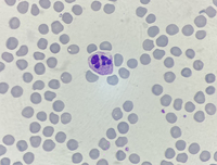 Neutrophil hyper-segmentation 6