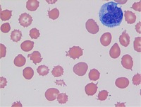 Spur Cell Anemia 1