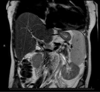 Spur Cell Anemia 2