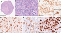 Classic Hodgkin lymphoma in the cerebellum: a rare site for a common disease