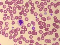 Giant platelets in Bernard Soulier Syndrome 2