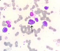 Flame Cells in Bone Marrow Aspirate (2)