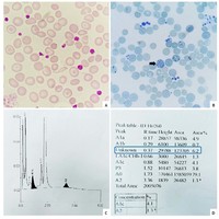 HbH disease