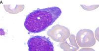 AML with inv(16)/CBFB::MYH11 Mimicking T/Myeloid MPAL by EGIL Criteria 1