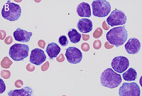 Extramedullary relapse of acute promyelocytic leukemia in cerebrospinal fluid 2